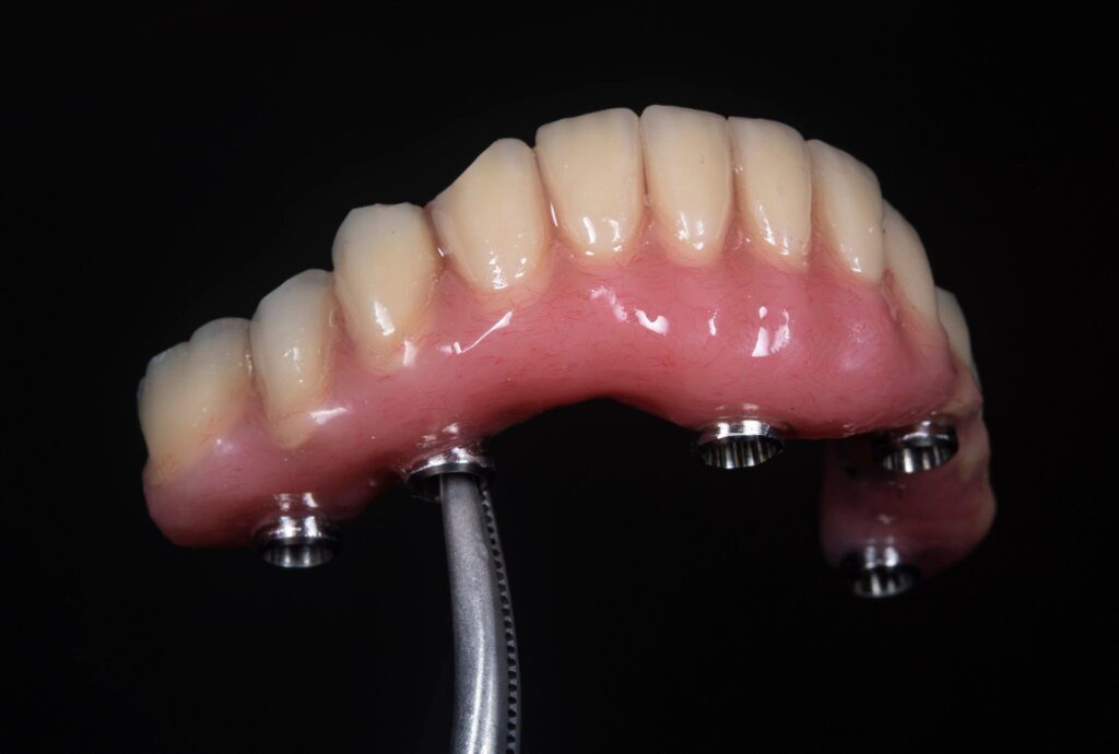 one day wall same day rehab -teeth done